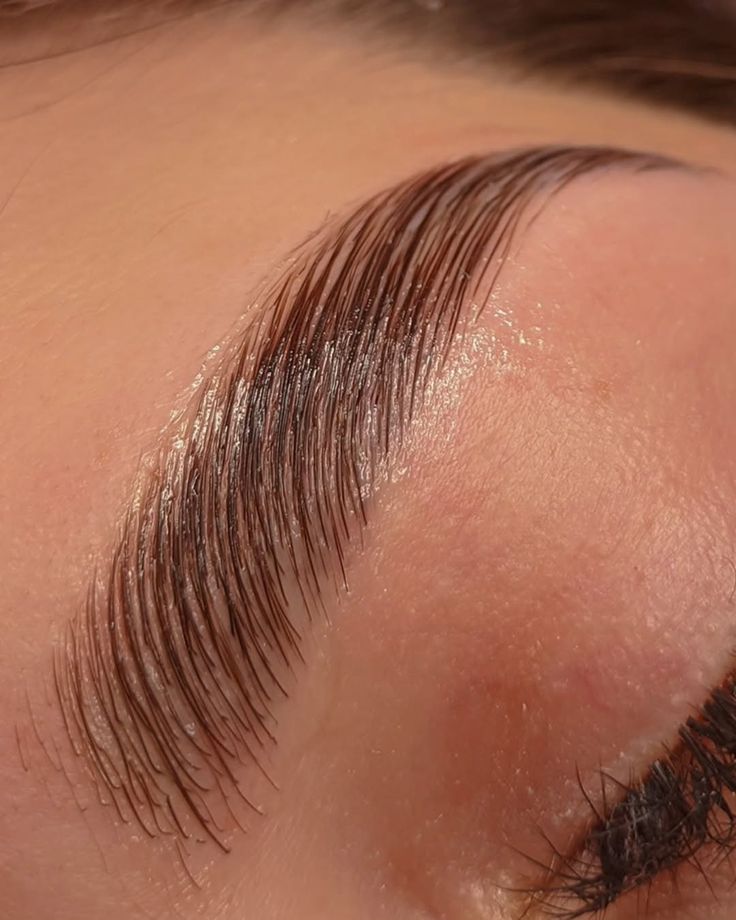 Brow Lift